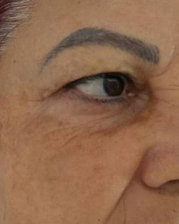 Antes